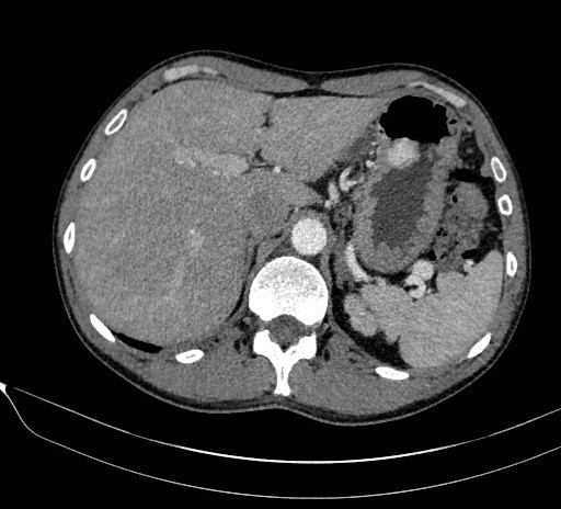 TDM abdominale après injection, coupe axiale