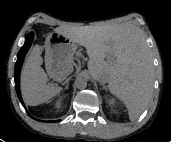TDM de l'étage abdominal supérieur, coupe axiale