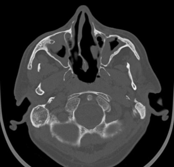 TDM du massif facial, coupe axiale en fenêtre osseuse