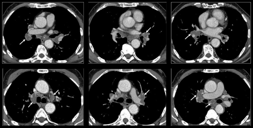 TDM thoracique injectée en fenêtre médiastinale : adénopathies hilaires et médiastinales, ganglions hypodenses à rehaussement périphérique