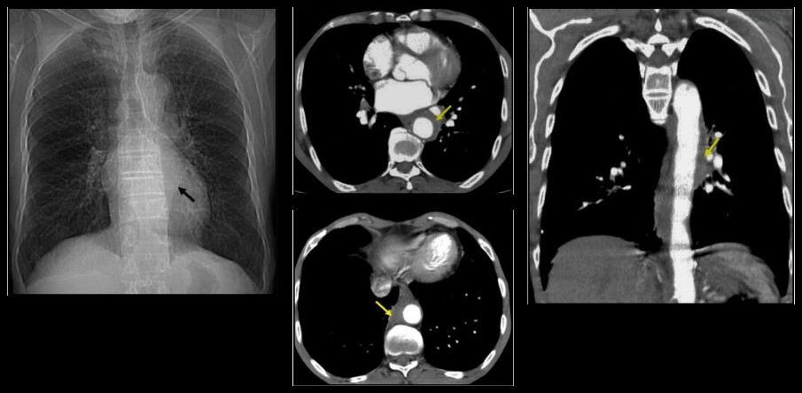 Radiographie thoracique de face, puis TDM thoracique injectée (coupes axiales et coronale) : manchon péri-aortique bifocal