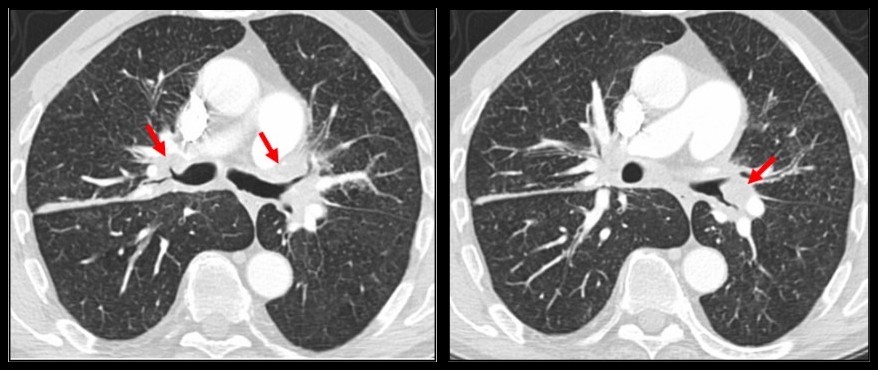 TDM thoracique en fenêtre parenchymateuse : manchon péri-bronchovasculaire rétrécissant les bronches lobaires supérieures