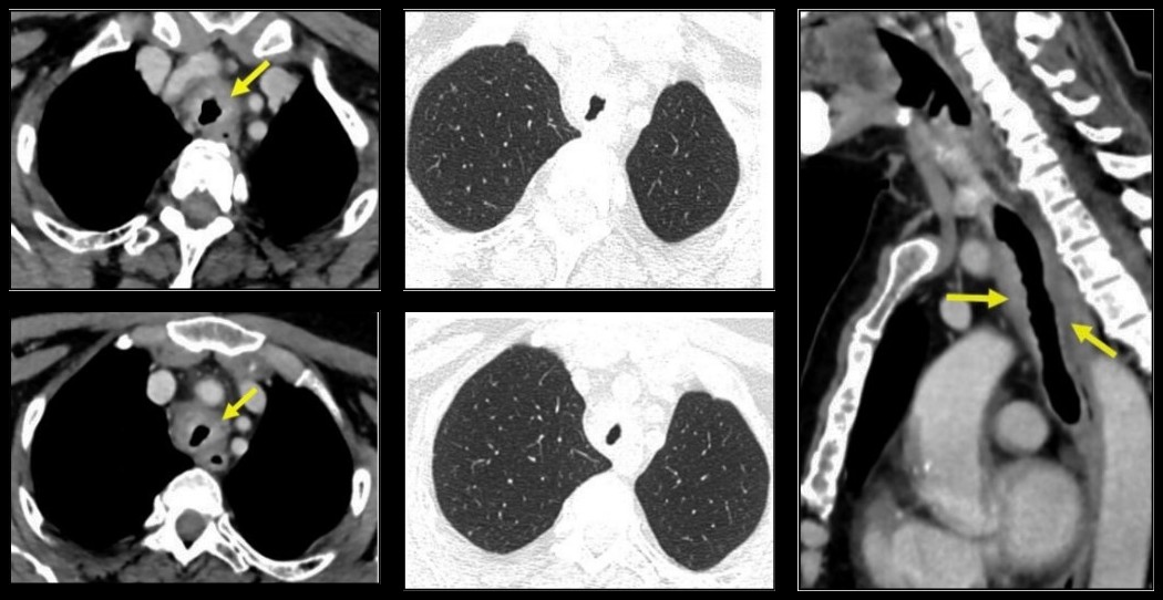 TDM thoracique injectée, coupes axiales en fenêtres médiastinale et parenchymateuse et reconstruction sagittale : épaississement circonférentiel de la paroi trachéale réduisant sa lumière