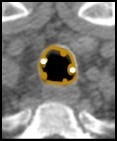 Trachée en coupe axiale : paroi épaissie (en orange), y compris la membrane postérieure, avec des calcifications