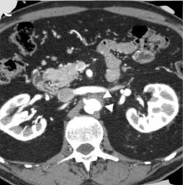 TDM axiale phase pancréatique — Fibrose rétropéritonéale