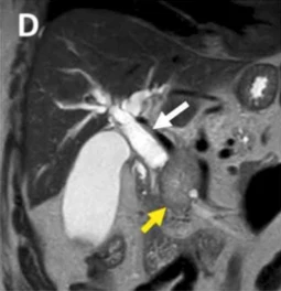 IRM T2 — Tumeur céphalique obstructive