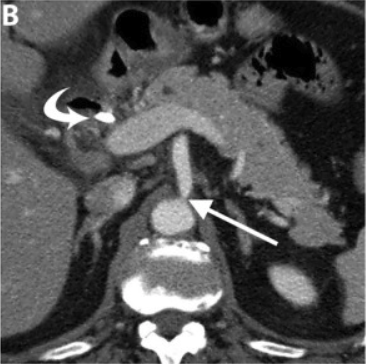 TDM axiale — Retentissement en coupe axiale