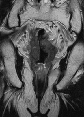IRM T2 coronale — CRM d'une tumeur du bas rectum