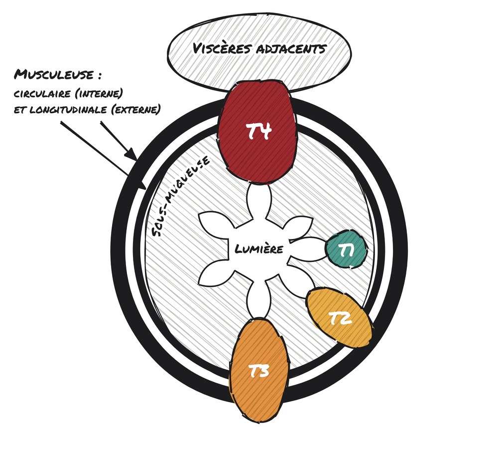 Schéma du staging T du cancer du rectum : T1 sous-muqueuse, T2 musculeuse, T3 au-delà de la musculeuse, T4 viscères adjacents