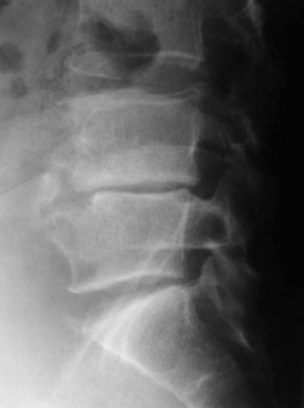 Radiographie de profil — bec de perroquet
