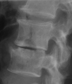 Radiographie de profil — vide discal