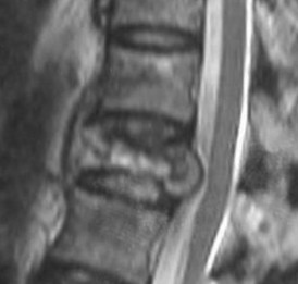 IRM sagittale — spondylite tuberculeuse