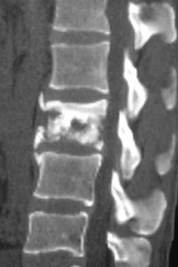 TDM sagittale — spondylite