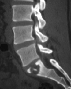 TDM sagittale — spondylite sans atteinte discale
