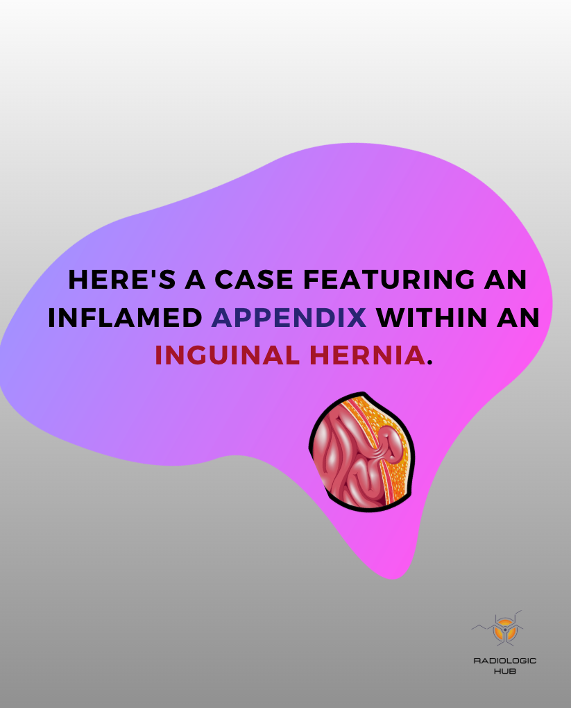 Cas : appendice inflammatoire dans une hernie inguinale