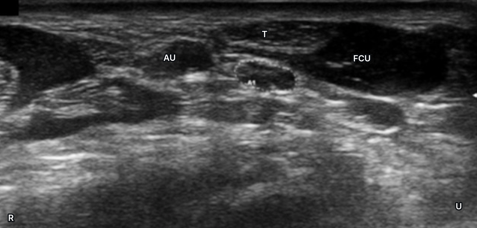 Coupe axiale au pli de flexion distal : artère ulnaire, nerf ulnaire entouré, FCU et son tendon