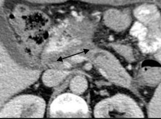 TDM à 7 mois — Pancréas caudal déconnecté.