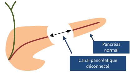 Schéma : canal pancréatique déconnecté, pancréas normal en distalité