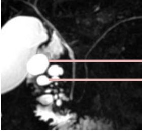 IRM T2 : microkystes de la paroi duodénale