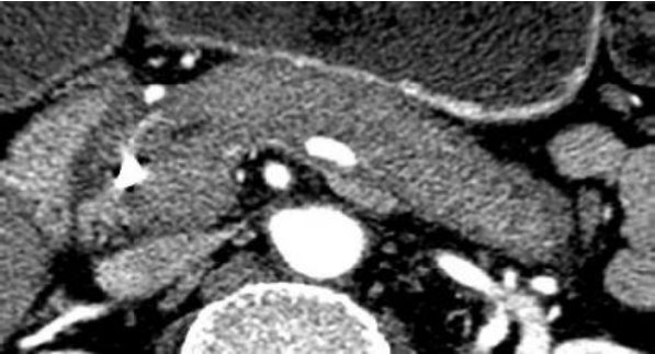TDM : pancréatite auto-immune diffuse