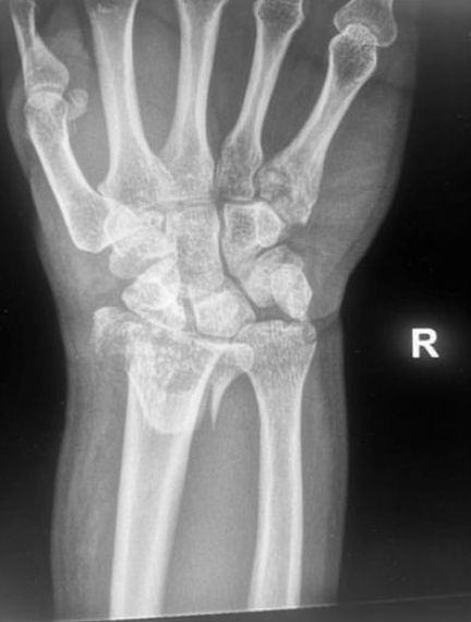 Barton palmaire : radiographie du poignet de face