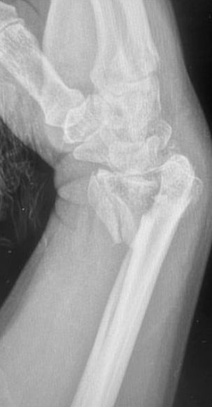 Barton palmaire : radiographie du poignet de profil