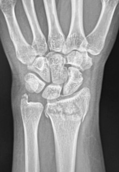 Pouteau-Colles : radiographie du poignet de face