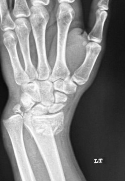 Goyrand-Smith : radiographie du poignet de face