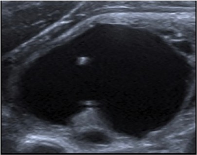 Échographie thyroïdienne : Colloïde (queue de comète)