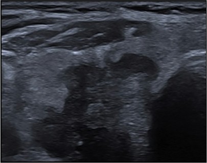 Échographie thyroïdienne : Contours irréguliers