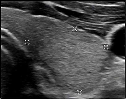 Échographie thyroïdienne : Hyperéchogène