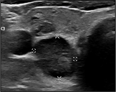 Échographie thyroïdienne : Hypoéchogénicité marquée