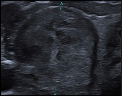 Échographie thyroïdienne : Hypoéchogénicité modérée