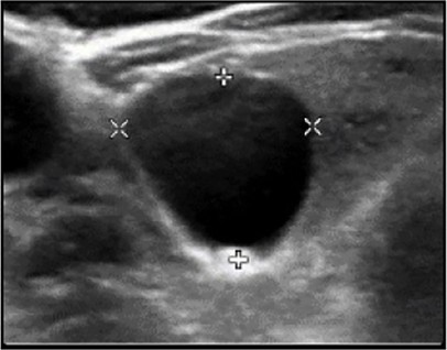 Échographie thyroïdienne : Kyste pur