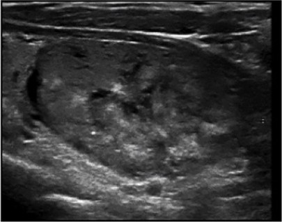 Échographie thyroïdienne : Microcalcifications