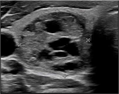 Échographie thyroïdienne : Nodule mixte : analyser la portion solide