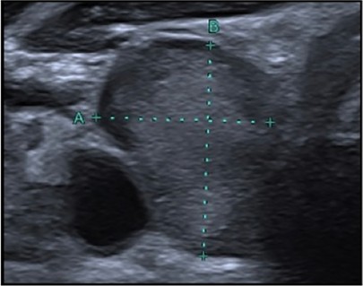 Échographie thyroïdienne : Plus épais que large