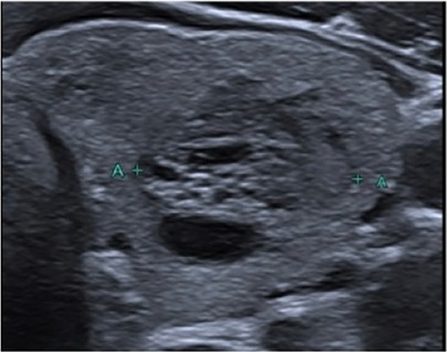 Échographie thyroïdienne : Spongiforme (si entièrement)