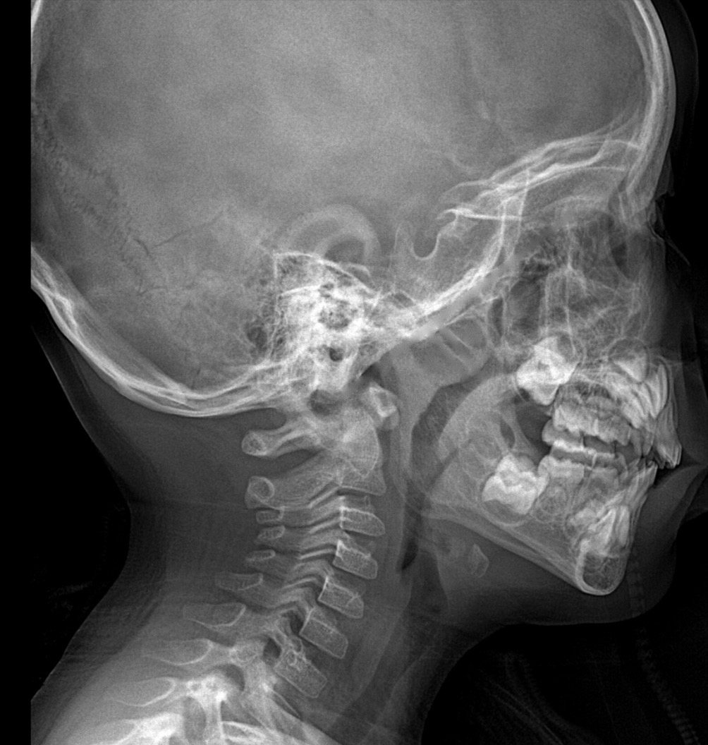 Radiographie du crâne et du cou de profil d'un enfant, sans légende
