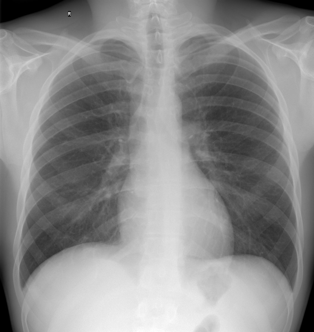 Radiographie thoracique de face normale, sans légende
