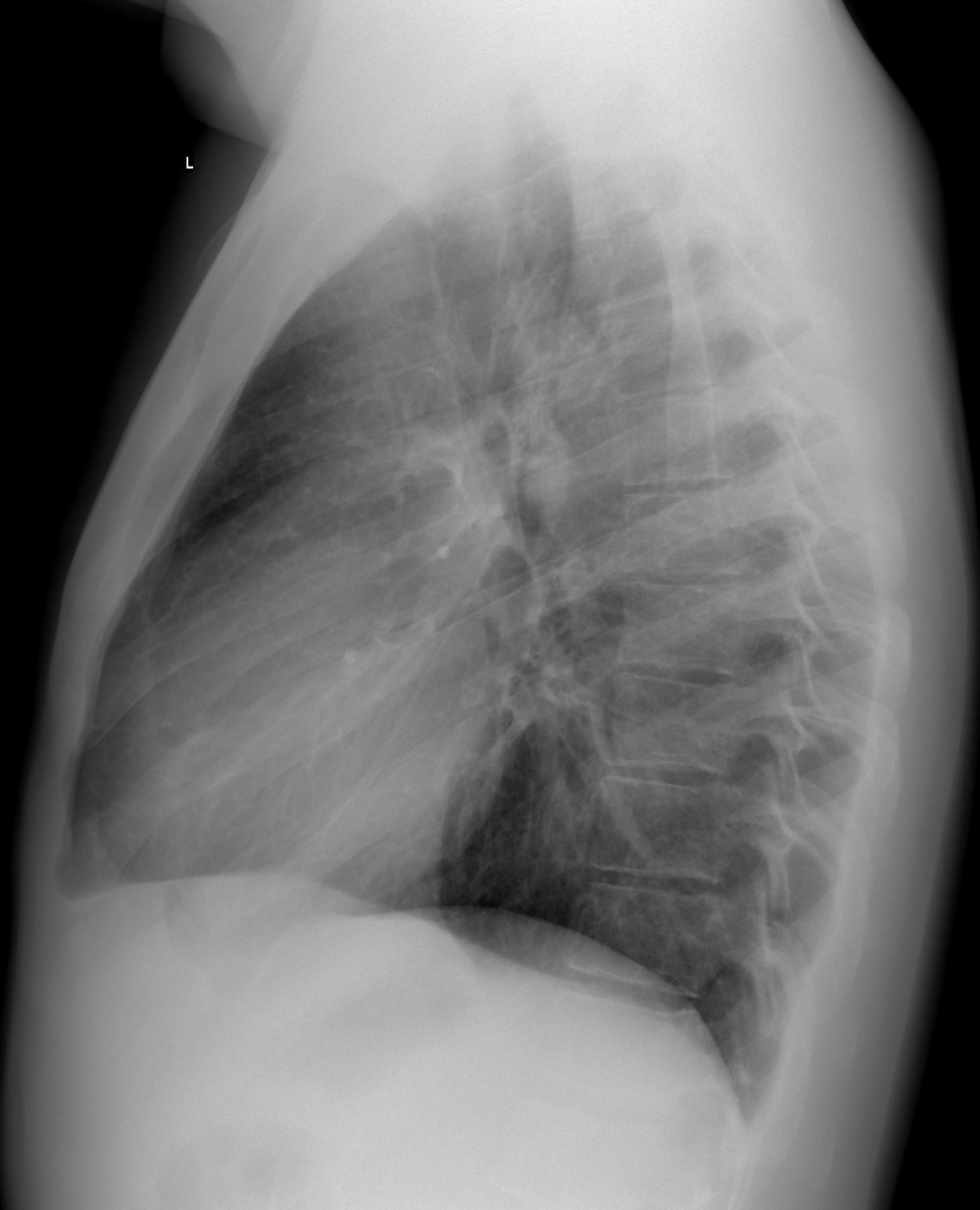 Radiographie thoracique de profil normale, sans légende